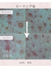 ル シャ/メンズ脱毛/毛穴洗浄/ヘッドスパ