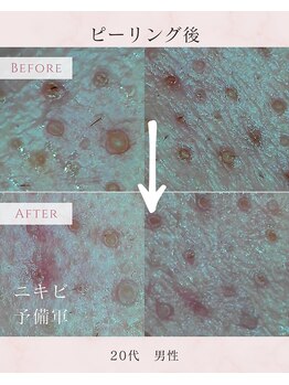 ル シャ/メンズ脱毛/毛穴洗浄/ヘッドスパ