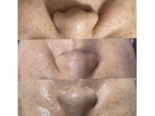 キレイになる路の雰囲気（老けて見えるほうれい線や透明感で10歳若見えお肌改善）
