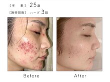 チップ(chip)/25歳／施術3回