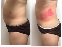 フラットベリー 恵比寿(Flat BELLY)/脂肪冷却4カップ