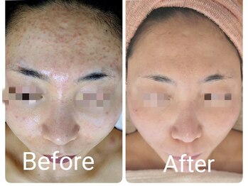 サロン ド ハニー(Salon de Honey)/ニキビケア・跡の改善◎