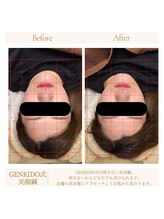 げんき堂整骨院/げんき堂鍼灸院 イオンタウン仙台富沢/【刺さない美容鍼】美顔鍼