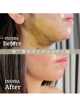 術後の女神 大阪心斎橋店/術後ケアインディバ・インディバ