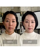 ハッピーアリスター(HAPPY ALISTER)/顔タイプ診断ビフォーアフター