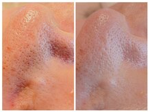 サロン ザ プマロ(SalonThePumalo)/たるみ毛穴と毛穴詰まり