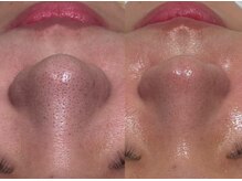 ラヴィン なんばスカイオ店(Lovin)/【ハイドロ毛穴洗浄 3回施術】