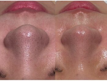 ラヴィン なんばスカイオ店(Lovin)/【ハイドロ毛穴洗浄 3回施術】