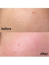 ティーアール(TR)/フェイシャルWax