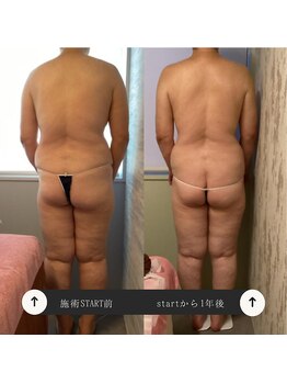 トータルサロン ヴィータ(VITA.)/ポールシェリー痩身/beforeafter