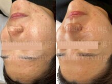 ハナワクシングプラス 高知(HanaWaxing+)/【ニキビ肌のためのワックス】