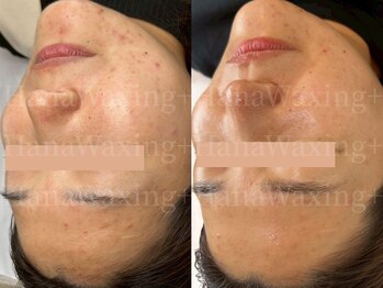 ハナワクシングプラス 高知(HanaWaxing+)/【ニキビ肌のためのワックス】