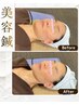 【美容鍼×フェイシャル セットコース♪】美容鍼(極-Kiwami-) 初回 ¥6,980