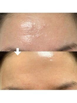 シェノン 赤坂大濠店/施術前→１週間後