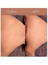 ヴィアス(vias)/背中脱毛