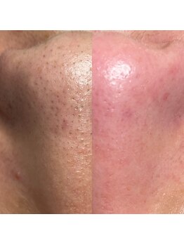 キキ(kiki)/Before&After