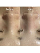 スピカ(Spica)/1回→ハーブ＆毛穴洗浄＆幹細胞