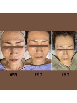 ミノア 大野城店(MINOA)/毛穴洗浄6回施術♪