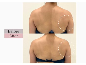 フロリール アザブジュウバン(FlorirAzabujuban)/痩身/はみ肉撃退/天使の羽