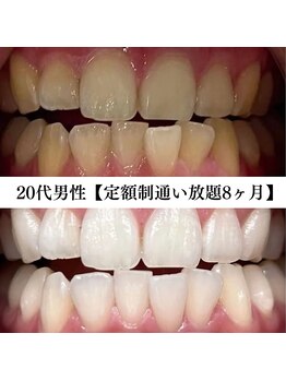 ホワイト 福岡天神店(WHITE)/ホワイトニングビフォーアフター
