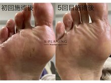 ロンディネ(Rondine)/韓国式足裏角質ケア