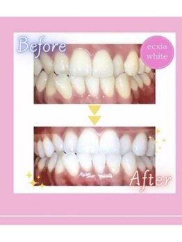 エクシアホワイト 立川南口店/ビフォーアフター