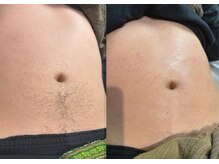 ピヴァーチェ(Pivace)/シュガーリング脱毛始めました♪