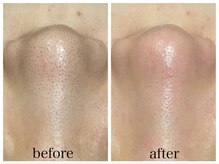 アリエス/ハイドラ×顔脱毛