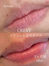 クレーヴ(CREVE)/モニター様経過写真【2ヶ月】