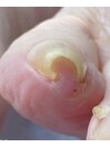 キツい巻き爪も改善へ♪