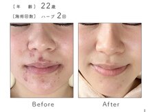 チップ(chip)/22歳／施術2回