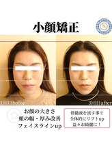 RKY/小顔矯正&頭蓋骨矯正3回（20代）