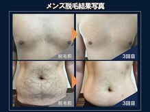 ゼロ 松阪店(ZERO)/胸、お腹脱毛