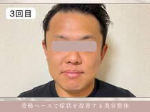 ほぐし屋 かすがい/3回目/小顔リフト＋美姿勢整体