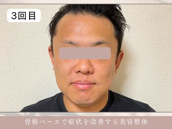 ほぐし屋 かすがい/3回目/小顔リフト+美姿勢整体