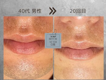 ル シャ/メンズ脱毛/毛穴洗浄/ヘッドスパ