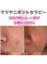 レイラニア(Leilani.Am)/毛穴ケア＆産毛にも最適