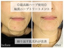 ラミーユ(La Miu)の雰囲気（繰り返す肌荒れや気になる跡を改善◎剥離なしでもこの効果◎）