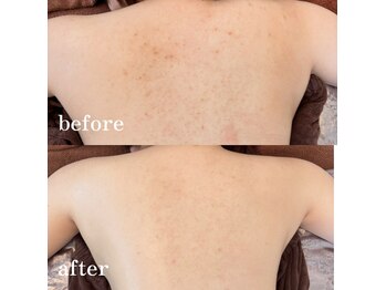 ベレミアム(Bellemium)/背中肌質改善5回