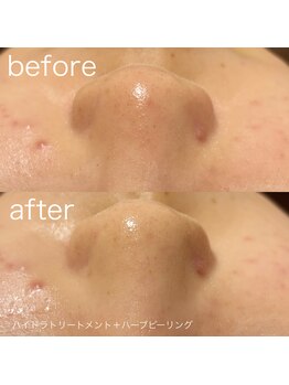 ルルラ リコ(lulula rico)/症例写真/ハイドラ毛穴洗浄