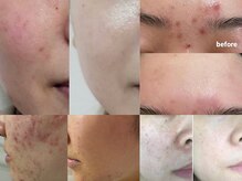 あらゆるお肌トラブルを毛穴から根本改善