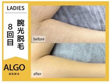 アルゴ 敦賀店(ALGO)/腕光脱毛8回目