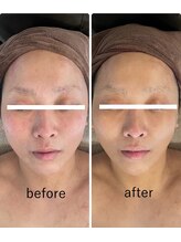 オレアグリーン 岡崎(OLEA green)/before after(筋膜リリース)