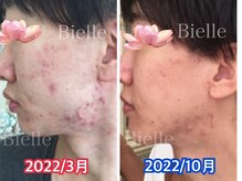 ビエル(Bielle)/近くで顔見られるのが嫌だった…