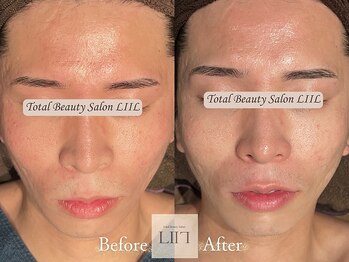 エル 麻布十番/たるみ/小顔/毛穴/フェイシャル