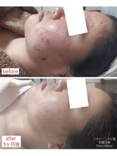ミュー(Mieux)/ビックリ！シミ化した跡も激変！
