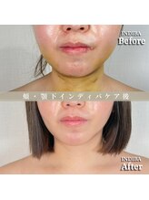 術後の女神 大阪心斎橋店/術後ケアインディバ・インディバ