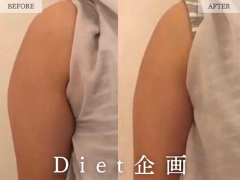 レヴェリー 心斎橋店(REVERIE)/‐ BODYお肉取り 二の腕 ‐