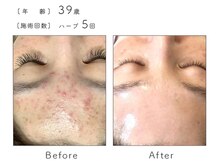 チップ(chip)/39歳／施術5回