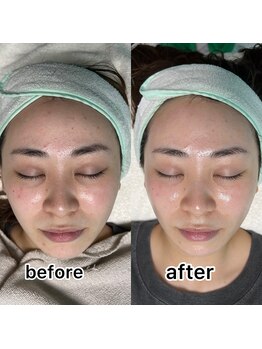 キノ(Kino)/ミルクピーリング★